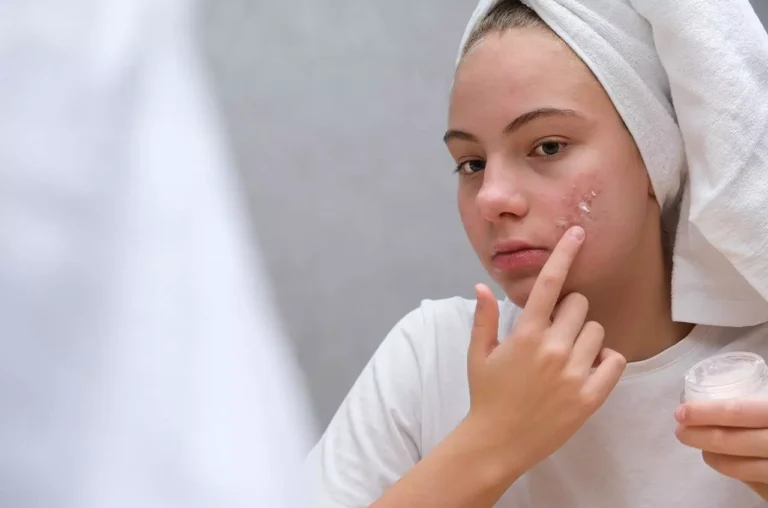 remedios naturales para el acné